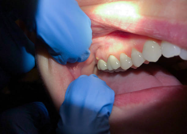 Best Emergency Gum Treatment in Hamilton City, CA
